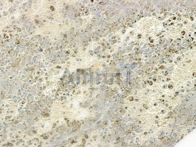 CHD9 Antibody - DF9384 at 1/100 staining human melanoma by IHC-P.