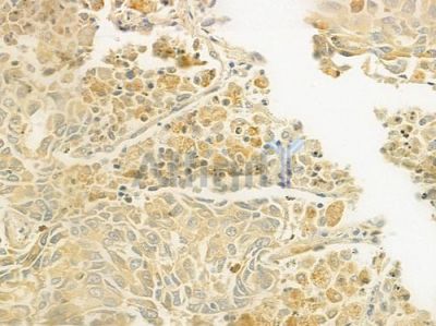 C1QTNF8 Antibody - DF9406 at 1/100 staining human prostate carcinoma by IHC-P.