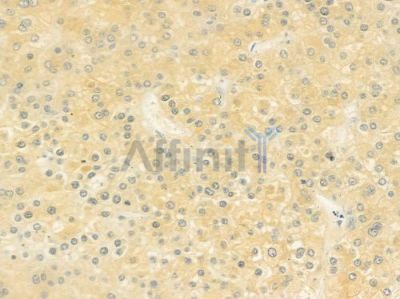 HACE1 Antibody - DF9477 at 1/100 staining human hepatocellular carcinoma by IHC-P.