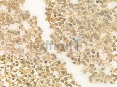 UBR2 Antibody - DF9491 at 1/100 staining human glioblastoma by IHC-P.
