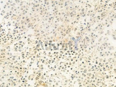 NEIL2 Antibody - DF9499 at 1/100 staining human Hodgkin lymphoma by IHC-P.