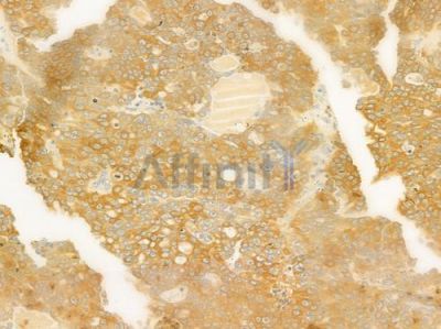 EIF3J Antibody - DF9509 at 1/100 staining human ovarian carcinoma by IHC-P.
