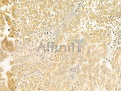 FBLN1 Antibody - DF9516 at 1/100 staining human lung squamous cell carcinoma by IHC-P.