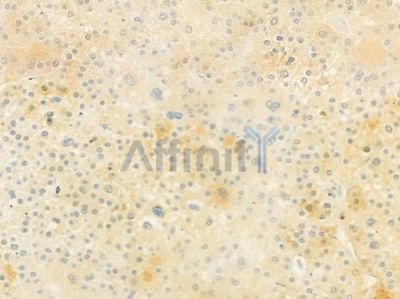 GPSM1 Antibody - DF9539 at 1/100 staining human hepatocellular carcinoma by IHC-P.