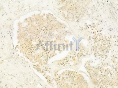 HNRPDL Antibody - DF9571 at 1/100 staining human prostate carcinoma by IHC-P.
