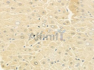 KCNJ13 Antibody - DF9597 at 1/100 staining human hepatocellular carcinoma by IHC-P.