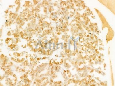 MED15 Antibody - DF9613 at 1/100 staining human renal cell carcinoma by IHC-P.