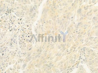 UNC5A Antibody - DF9679 at 1/100 staining human lung squamous cell carcinoma by IHC-P.