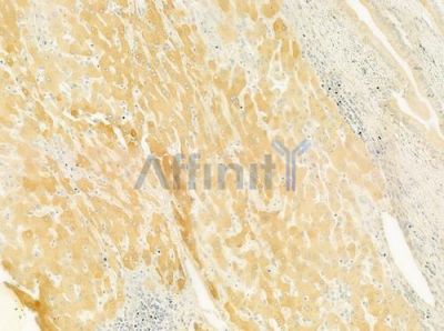 CHRNB4 Antibody - DF9698 at 1/100 staining human hepatocellular carcinoma by IHC-P.