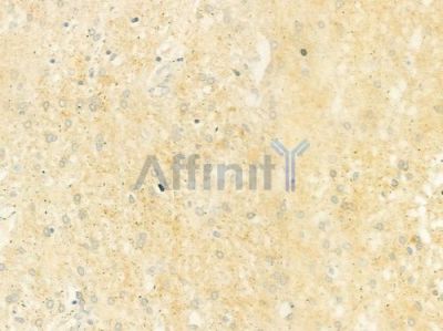 RAB22A Antibody - DF9820 at 1/100 staining human glioblastoma by IHC-P.