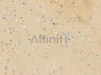 RAB23 Antibody - DF9821 at 1/100 staining human glioblastoma by IHC-P.