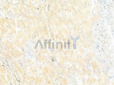 RAB33B Antibody - DF9826 at 1/100 staining human hepatocellular carcinoma by IHC-P.