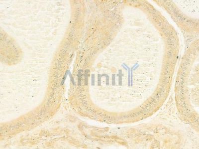 RAB43 Antibody - DF9833 at 1/100 staining human testicular cancer by IHC-P.
