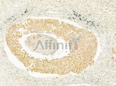 RELN Antibody - DF9843 at 1/100 staining human lung squamous cell carcinoma by IHC-P.