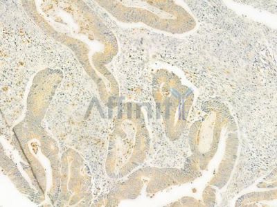 RELN Antibody - DF9843 at 1/100 staining human colon carcinoma by IHC-P.