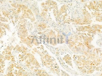 RELN Antibody - DF9843 at 1/100 staining human lung squamous cell carcinoma by IHC-P.