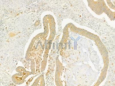 RELN Antibody - DF9843 at 1/100 staining human colon carcinoma by IHC-P.