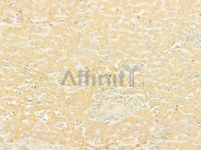 SFRP3 Antibody - DF9879 at 1/100 staining human hepatocellular carcinoma by IHC-P.