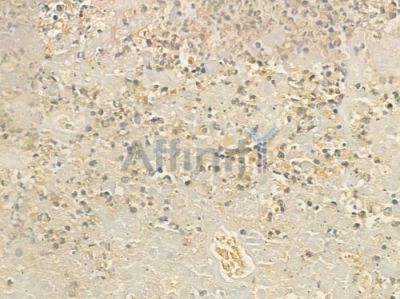 CCL1 Antibody - DF9910 at 1/100 staining human prostate carcinoma by IHC-P.