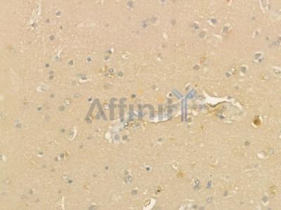 CCL1 Antibody - DF9910 at 1/100 staining human glioblastoma by IHC-P.