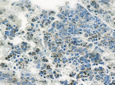 Phospho-HBP1 (Ser402) Antibody - AF0031 at 1/100 staining human melanoma by IHC-P.