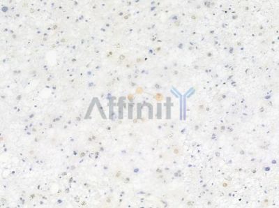 Phospho-hnRPD (Ser83) Antibody - AF0033 at 1/100 staining human astrocytoma by IHC-P.