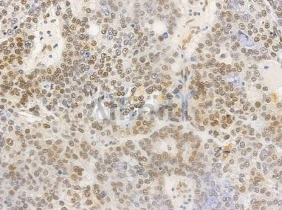 Phospho-hnRPD (Ser83) Antibody - AF0033 at 1/100 staining human ovarian carcinoma by IHC-P.