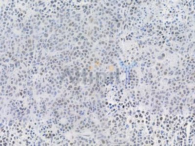 Phospho-hnRPD (Ser83) Antibody - AF0033 at 1/100 staining human non-Hodgkin lymphoma by IHC-P.