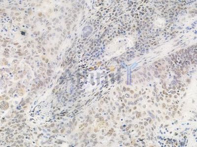 Phospho-hnRPD (Ser83) Antibody - AF0033 at 1/100 staining human esophageal carcinoma by IHC-P.