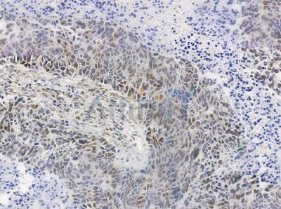 Phospho-hnRPD (Ser83) Antibody - AF0033 at 1/100 staining human large cell lung carcinoma by IHC-P.