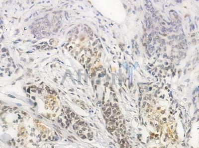 Phospho-hnRPD (Ser83) Antibody - AF0033 at 1/100 staining human breast carcinoma by IHC-P.