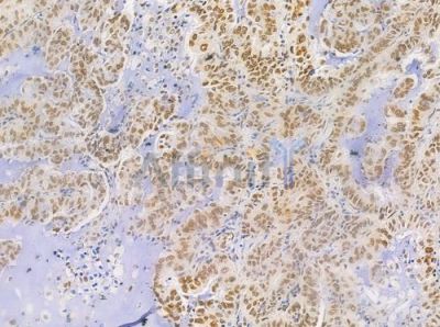 Phospho-hnRPD (Ser83) Antibody - AF0033 at 1/100 staining human lung adenocarcinoma by IHC-P.