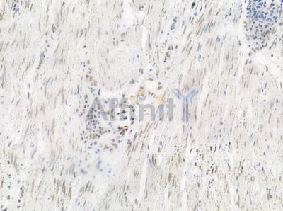 Phospho-hnRPD (Ser83) Antibody - AF0033 at 1/100 staining human colon carcinoma by IHC-P.