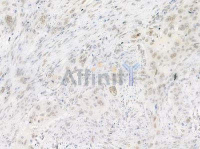 Phospho-hnRPD (Ser83) Antibody - AF0033 at 1/100 staining human tongue carcinoma by IHC-P.