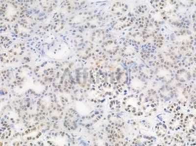 Phospho-hnRPD (Ser83) Antibody - AF0033 at 1/100 staining human renal cell carcinoma by IHC-P.