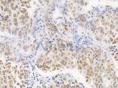 Phospho-hnRPD (Ser83) Antibody - AF0033 at 1/100 staining human lung squamous cell carcinoma by IHC-P.