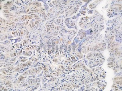 Phospho-hnRPD (Ser83) Antibody - AF0033 at 1/100 staining human lung adenocarcinoma by IHC-P.