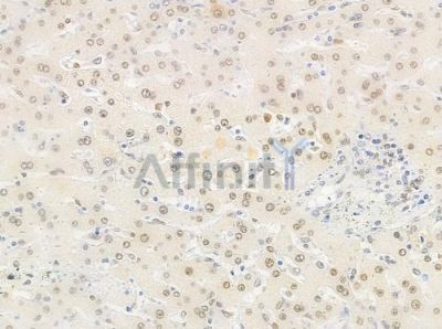 Phospho-hnRPD (Ser83) Antibody - AF0033 at 1/100 staining human hepatocellular carcinoma by IHC-P.