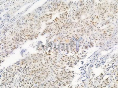 Phospho-hnRPD (Ser83) Antibody - AF0033 at 1/100 staining human lung squamous cell carcinoma by IHC-P.