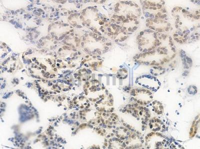 Phospho-hnRPD (Ser83) Antibody - AF0033 at 1/100 staining human renal cell carcinoma by IHC-P.