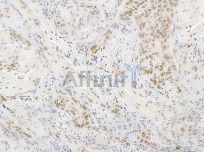 Phospho-hnRPD (Ser83) Antibody - AF0033 at 1/100 staining human tongue carcinoma by IHC-P.