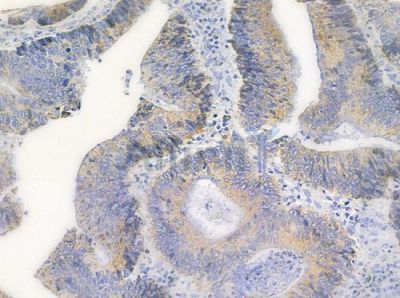 Phospho-FER (Tyr402) Antibody - AF0044 at 1/100 staining human colon carcinoma by IHC-P.