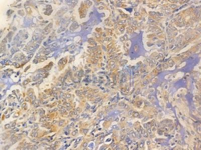 Phospho-FER (Tyr402) Antibody - AF0044 at 1/100 staining human lung adenocarcinoma by IHC-P.