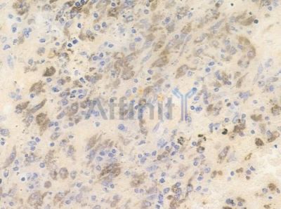Phospho-PAK3 (Ser154) Antibody - AF0046 at 1/100 staining human melanoma by IHC-P.