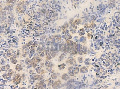 hnRPD Antibody - AF0092 at 1/100 staining human thymoma by IHC-P.