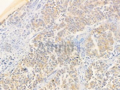 hnRPD Antibody - AF0092 at 1/100 staining human lung squamous cell carcinoma by IHC-P.