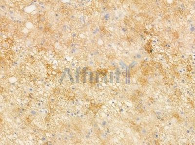 IL-2R beta/CD122 Antibody - AF0093 at 1/100 staining human astrocytoma by IHC-P.