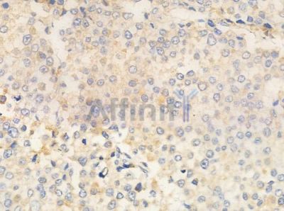 IL-2R beta/CD122 Antibody - AF0093 at 1/100 staining human prostate carcinoma by IHC-P.