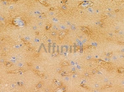 IL-2R beta/CD122 Antibody - AF0093 at 1/100 staining human glioblastoma by IHC-P.