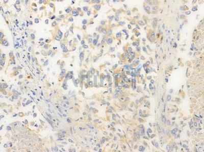 IL-2R beta/CD122 Antibody - AF0093 at 1/100 staining human lung squamous cell carcinoma by IHC-P.